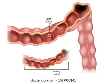 Colon Polyps. Vector Illustration- Polyp In The Intestine.