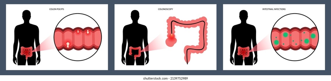 Colon polyps and viral infections. Colonoscopy procedure. Viral, bacterial or parasitic infection in intestine. Gastroenteritis, inflammation of the digestive system. Medical flat vector illustration.