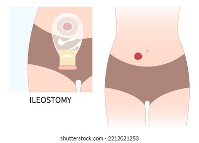 Colon removal Surgery with abdomen Pouch for Small Large stoma of Crohn and Hirschsprung disease blocked inflammation hernia Cancer Tumor to poo stool Loop invasive tract Rectal ileum system