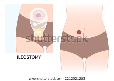Colon removal Surgery with abdomen Pouch for Small Large stoma of Crohn and Hirschsprung disease blocked inflammation hernia Cancer Tumor to poo stool Loop invasive tract Rectal ileum system