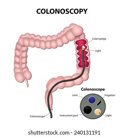 colonoscope in the colon. detail of the colonoscope