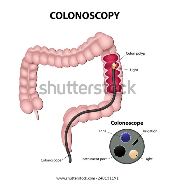 Colonoscope Colon Detail Colonoscope Stock Vector Royalty Free