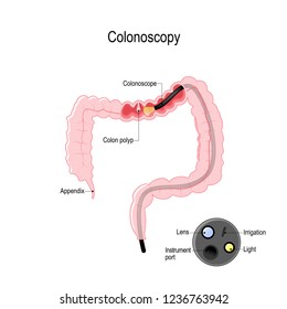 Colonoscopy in the colon. detail of the colonoscope. Vector illustration for biological, medical and science use