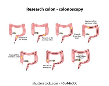 Colonoscopy. Diagnosis of the colon. Infographics. Vector illustration on isolated background.