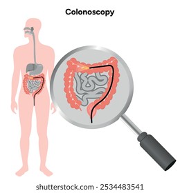 Colonoscopy diagram gastroscopy with endoscope 	