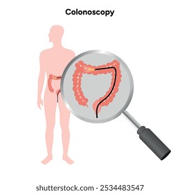 Diagrama de colonoscopia gastroscopía con endoscopio 	