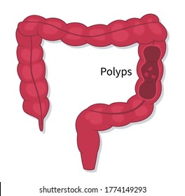 Colonoscopy endoscopic examination of the large bowel. Colorectal cancer screening. Flat vector illustration of polyps fleshy growth removing procedure on white background.