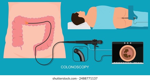 Colonoscopy is an exam used to look for changes such as swollen, irritated tissues, polyps or cancer in the large intestine and rectum.During a colonoscopy, flexible tube is inserted into the rectum.