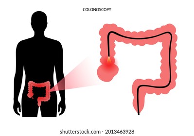 Colonoscopy exam vector illustration. Detecting changes or abnormalities in the large intestine. Colonoscope is inserted into the rectum. Video camera on the tube allows to view inside of entire colon
