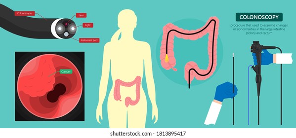 Colonoscopy an examination to detect abnormalities in the large intestine and rectum Polypectomy procedure remove polyps colon medical
