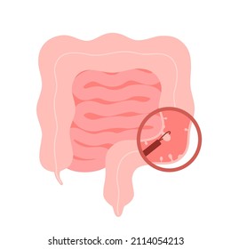 Darm der Koloskopie, Verfahren der Polypektomie, Entfernen von Polyp im Kolon. Darmerkrankungen, Kolonoperationen. Darmoperationen. Vektorgrafik