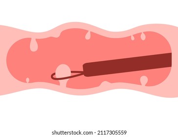 Colonoscopy intestine, polypectomy procedure, removal polyp in colon. Checkup gut, colon surgery. Operation intestine. Vector illustration