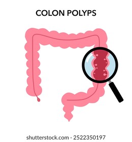 Colonoscopia intestinal, procedimento de polipectomia, remoção de pólipo no cólon. Checkup intestinal, cirurgia do cólon. Ilustração do vetor do intestino da operação.