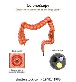 colonoscopy in the large bowel. Close-up of colonoscope, and Colorectal polyp. Cross section of a colon. Vector illustration