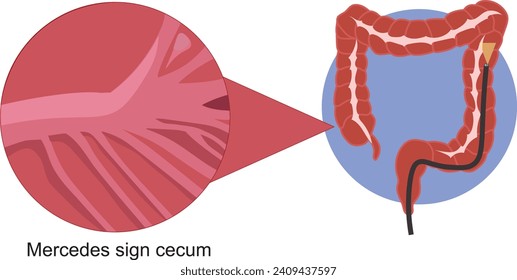 colonoscopia del intestino grueso 