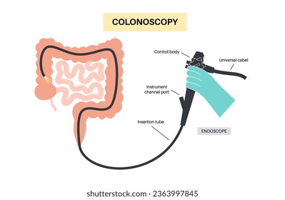 Colonoscopy is a minimally invasive procedure. Examination and treatment of the large intestine. Disorder of the colon, polyps, inflammation or swelling of bowel. Gastrointestinal disorder flat vector