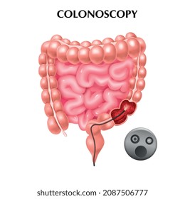 Cartel coloreado con anatomía intestinal y colonoscopio para el diagnóstico de colon ilustración vectorial realista