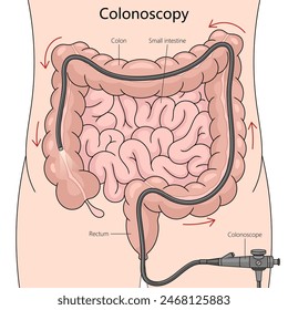 colonoscopy procedure, detailing the path of the colonoscope through the colon and small intestine diagram hand drawn schematic vector illustration. Medical science educational illustration