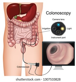 Colonoscopy procedure labeled 3d vector diagram on white background