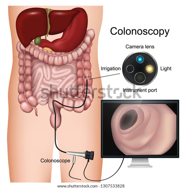 Colonoscopy procedure labeled 3d vector\
diagram on white\
background