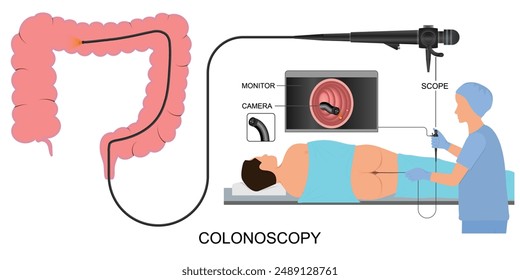 Colonoscopy is a procedure to look inside the colon for cancer or other abnormalities, normally performed by a gastroenterologist.During a colonoscopy, flexible tube is inserted into the rectum.