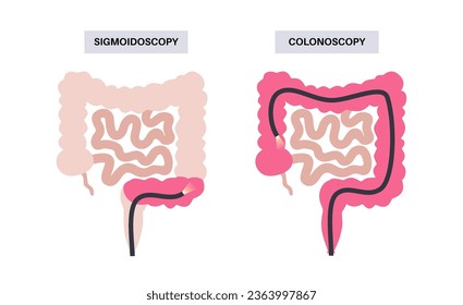 Colonoscopy and sigmoidoscopy test. Examination and treatment of the large intestine. Disorder of the colon, inflammatory bowel disease, constipation or incontinence. Gastrointestinal medical vector