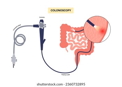 Colonoscopy treatment, familial adenomatous polyposis. Examination and diagnosis of the large intestine. FAP medical examination, bowel disease symptoms. Gastrointestinal disorder anatomical vector
