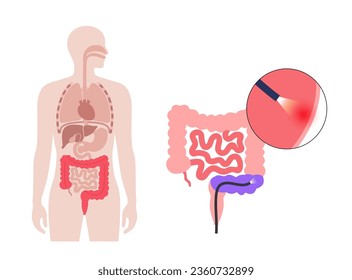 Colonoscopy treatment, familial adenomatous polyposis. Examination and diagnosis of the large intestine. FAP medical examination, bowel disease symptoms. Gastrointestinal disorder anatomical vector