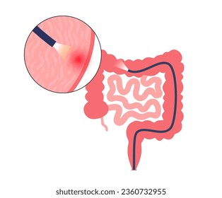 Colonoscopy treatment, familial adenomatous polyposis. Examination and diagnosis of the large intestine. FAP medical examination, bowel disease symptoms. Gastrointestinal disorder anatomical vector