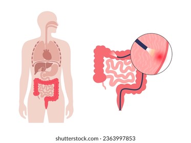 Colonoscopy treatment, familial adenomatous polyposis. Examination and diagnosis of the large intestine. FAP medical examination, bowel disease symptoms. Gastrointestinal disorder anatomical vector