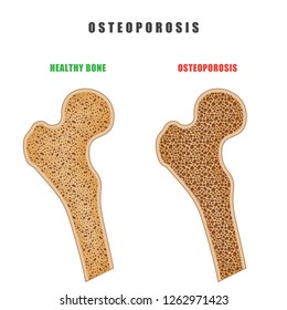 Color drawing of human thigh bone with osteoporosis problem on white background. Two bones are normal and sore. Vector illustration of the medical problem of osteoporosis disease