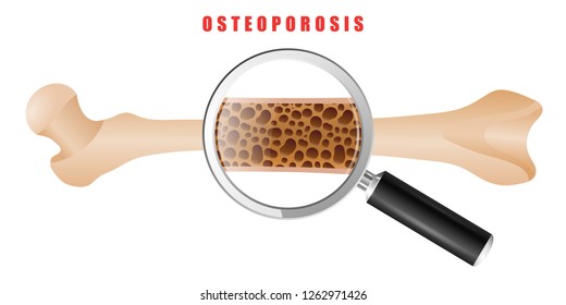 Color drawing of human thigh bone with osteoporosis problem on white background. Two bones are normal and sore. Vector illustration of the medical problem of osteoporosis disease