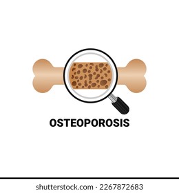 Color drawing of human thigh bone with osteoporosis problem on white background. Two bones are normal and sore. Vector illustration of the medical problem of osteoporosis disease