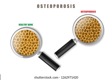 Color image of a human bone in cut with medicine problem of osteoporosis on a white background with magnifying glasses Vector item Osteoporosis under a microscope research invention treatment.