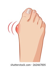 Color vector foot with a painful bunion