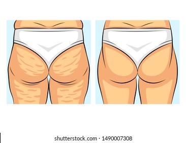 Color vector illustration before and after losing weight. Girl back view. Female figure with and without cellulite. Fat deposits on the female hips. Female buttocks problem areas.