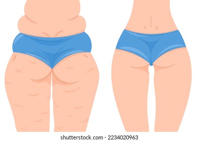 Ilustración del vector de color antes y después de perder peso. Vista posterior femenina con y sin celulitis. Nalgas femeninas en una lana azul