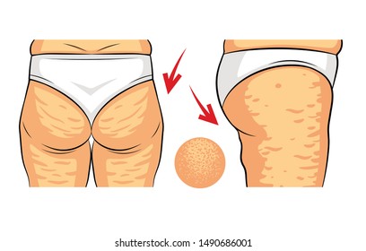 Color vector illustration of cellulite problem. Female hips rear view and side view. Fat deposits on the female buttocks. Hip with orange peel macro view