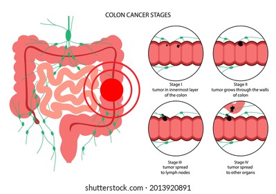 Colorectal Cancer Concept. Development Of Cancer From The Colon Or Rectum To The Whole Large Intestine. Stages Of Spreading Tumor To The Lymph Nodes And Other Internal Organs Vector Flat Illustration.