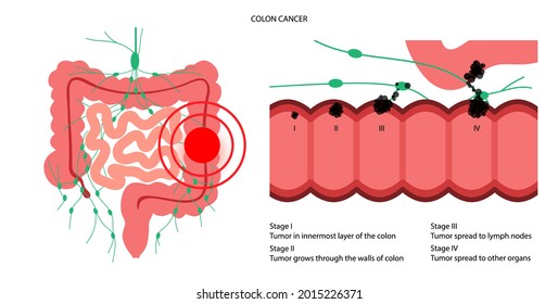 Colorectal Cancer Concept. Development Of Cancer From The Colon Or Rectum To The Whole Large Intestine. Stages Of Spreading Tumor To The Lymph Nodes And Other Internal Organs Vector Flat Illustration.