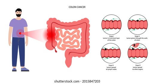 Colorectal Cancer Concept. Development Of Cancer From The Colon Or Rectum To The Whole Large Intestine. Stages Of Spreading Tumor To The Lymph Nodes And Other Internal Organs Vector Flat Illustration.