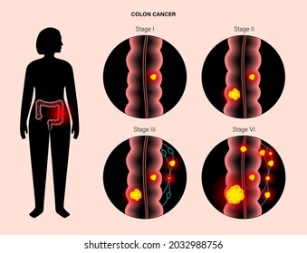 Colorectal cancer concept. Development of cancer from the colon or rectum to the whole large intestine. Stages of spreading tumor to the lymph nodes and other internal organs 3d vector illustration.