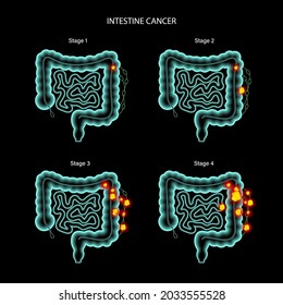 Colorectal Cancer Concept. Development Of Cancer From The Colon Or Rectum To The Whole Large Intestine. Stages Of Spreading Tumor To The Lymph Nodes And Other Internal Organs 3d Vector Illustration.