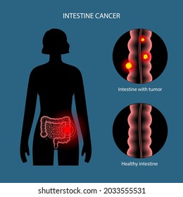 Colorectal Cancer Concept. Development Of Cancer From The Colon Or Rectum To The Whole Large Intestine. Stages Of Spreading Tumor To The Lymph Nodes And Other Internal Organs 3d Vector Illustration.