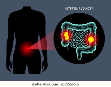 Colorectal Cancer Concept. Development Of Cancer From The Colon Or Rectum To The Whole Large Intestine. Stages Of Spreading Tumor To The Lymph Nodes And Other Internal Organs 3d Vector Illustration.