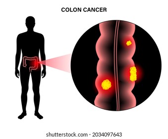 Colorectal Cancer Concept. Development Of Cancer From The Colon Or Rectum To The Whole Large Intestine. Stages Of Spreading Tumor To The Lymph Nodes And Other Internal Organs 3d Vector Illustration.