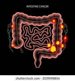 Colorectal Cancer Concept. Development Of Cancer From The Colon Or Rectum To The Whole Large Intestine. Stages Of Spreading Tumor To The Lymph Nodes And Other Internal Organs 3d Vector Illustration.