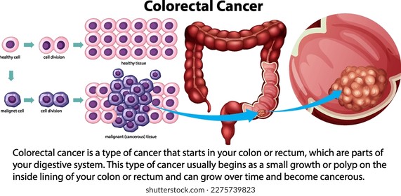 Colorectal Cancer with explanation illustration