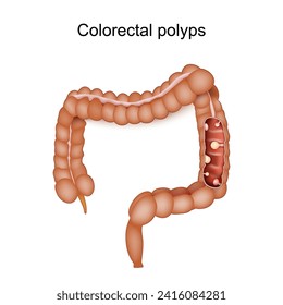 Colorectal polyps and Colon cancer. Human large intestine with Consequence of inflammatory bowel disease. Vector illustration