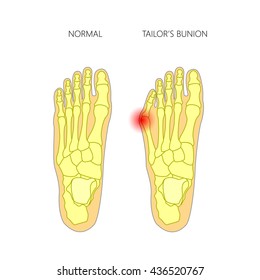 Colored Illustration Tailors Bunion Used Gradient Stock Vector (Royalty ...